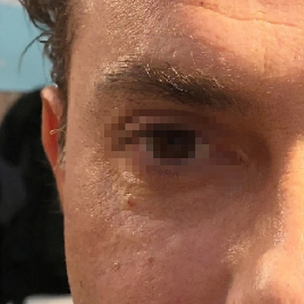 After-view photo for a FotroHIFU crow's feet treatment comparison