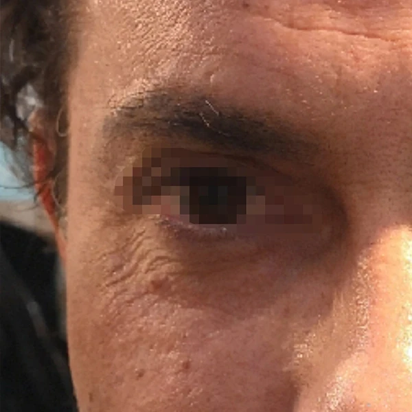 Before-view photo for a FotroHIFU crow's feet treatment comparison