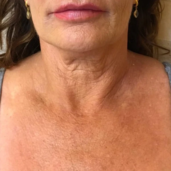 After-view photo for a FotroHIFU decolletage treatment comparison