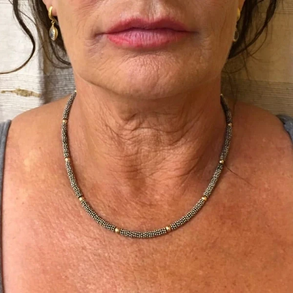 Before-view photo for a FotroHIFU decolletage treatment comparison