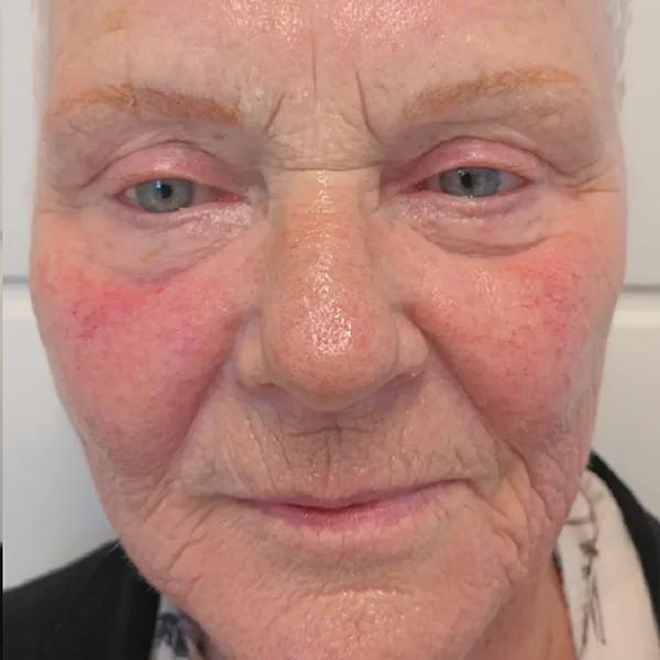 After-view photo for a FotroHIFU face lifting and rejuvenation comparison
