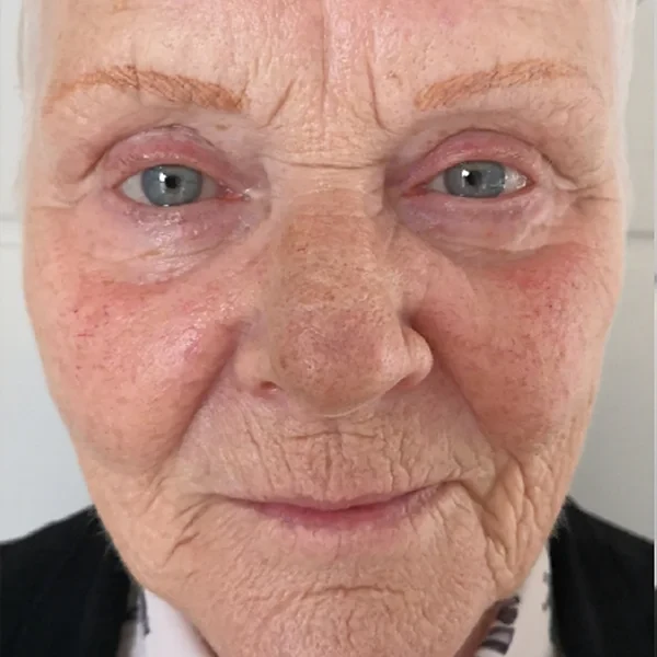 Before-view photo for a FotroHIFU face lifting and rejuvenation comparison