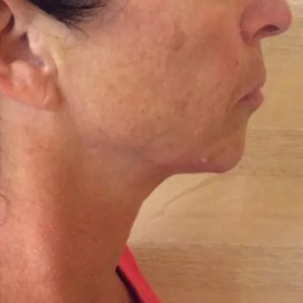 After-view photo for a FotroHIFU jawline contouring comparison