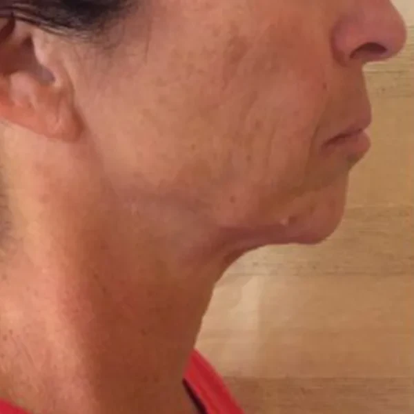 Before-view photo for a FotroHIFU jawline contouring comparison