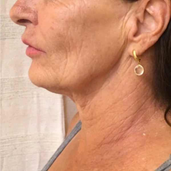 After-view photo for a FotroHIFU neck line treatment comparison