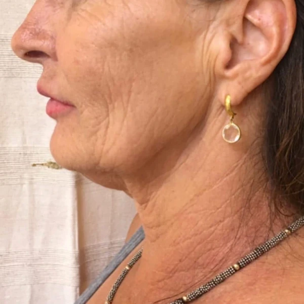 Before-view photo for a FotroHIFU neck line treatment comparison