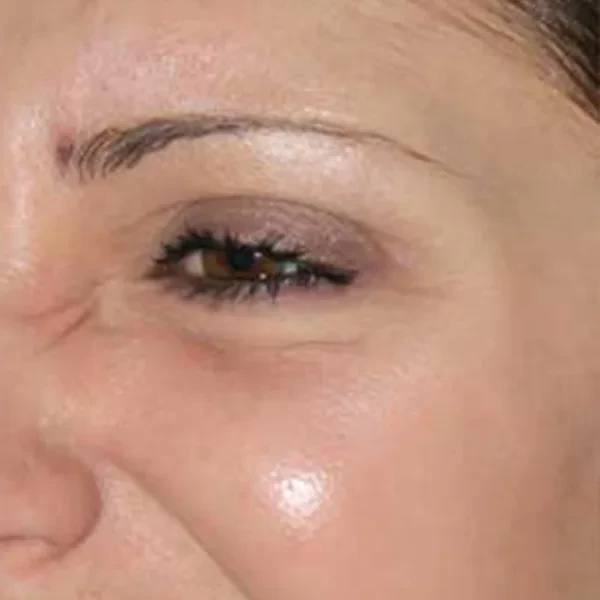 After-view photo for a FotroHIFU periorbital wrinkle treatment comparison