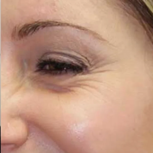 Before-view photo for a FotroHIFU periorbital wrinkle treatment comparison