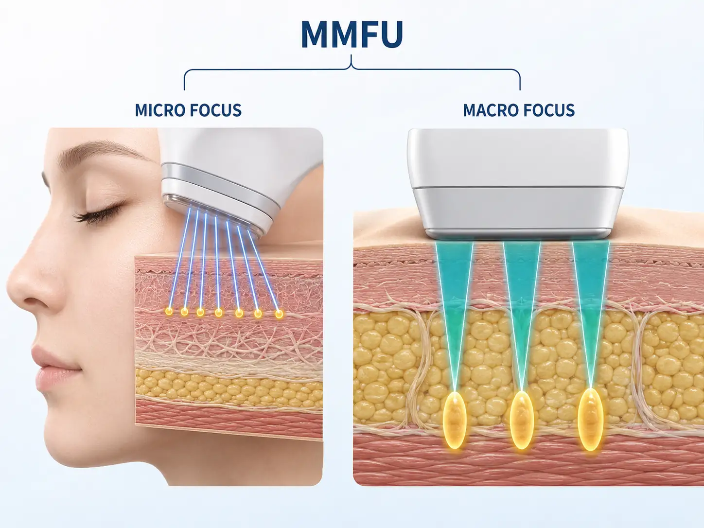 MMFU diagram comparing micro focus for facial precision with macro focus for deeper tissue coverage